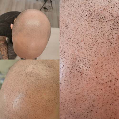 Tricopigmentaçao (1)