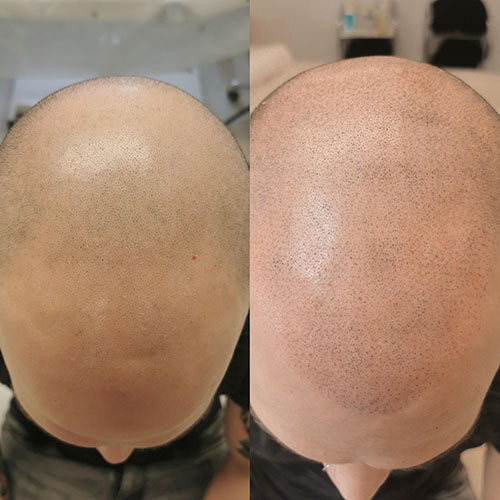 Tricopigmentaçao (2)