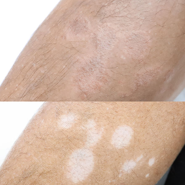 Vitiligo