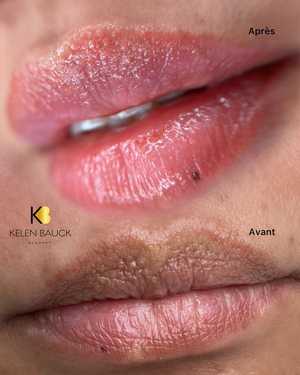 Dermopigmentation 7