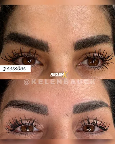 [30]-[FEED]-[SOBRANCELHA]-Resultado-de-procedimento PT