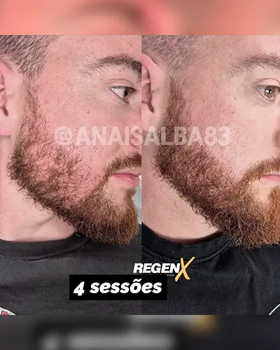 Anais-Alba-@anaisalba83---cabelo-a2---4-sessões