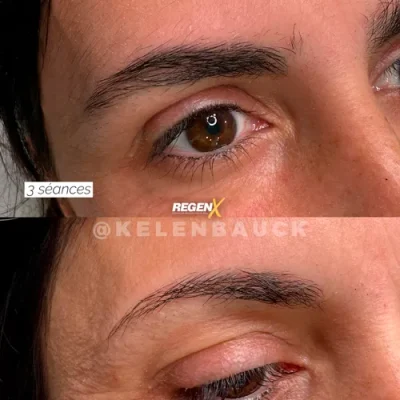 [31]-[FEED]-[SOBRANCELHA]-Resultado-de-procedimento