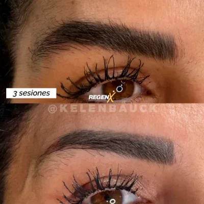 [32]-[FEED]-[SOBRANCELHA]-Resultado-de-procedimento ESP