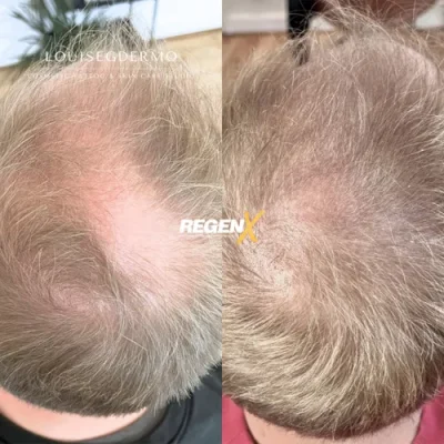 Louise Geertsen - Cabelo A 18-06-2025