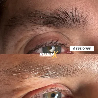 Sobrancelha 4 seções ESP